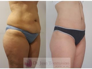 LIPOABDOMINOPLASTIA 