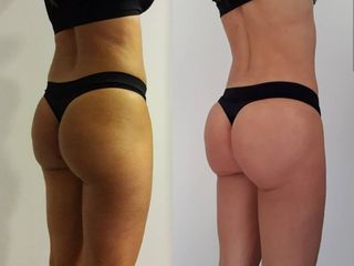 Lipoescultura