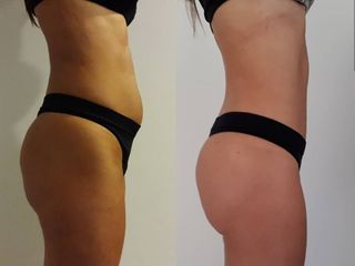 Mini LIPOABDOMINOPLASTIA 
