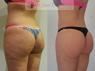 Lipogluteoplastia 