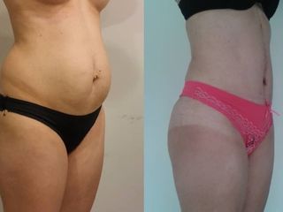 LIPOABDOMINOPLASTIA 