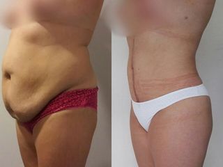 Abdominoplastia en Ancla