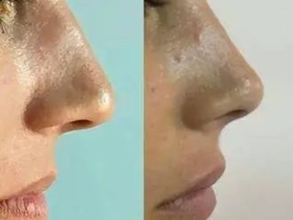 Rinomodelación antes y después - 877368