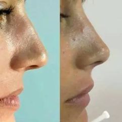 Rinomodelación - Elimay