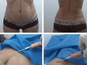 Lipoescultura antes y después - 877370