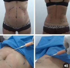 Lipoescultura - Elimay