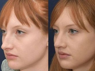 Rinomodelación antes y después - 877371