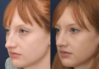 Rinomodelación - Elimay