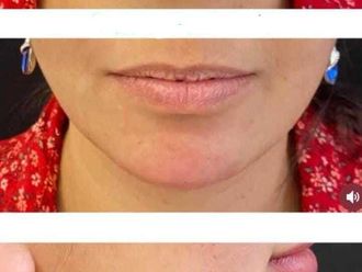 Mentoplastia antes y después - 877373