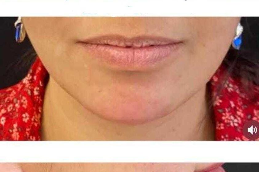 Mentoplastia antes y después - 877373