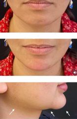 Mentoplastia - Elimay