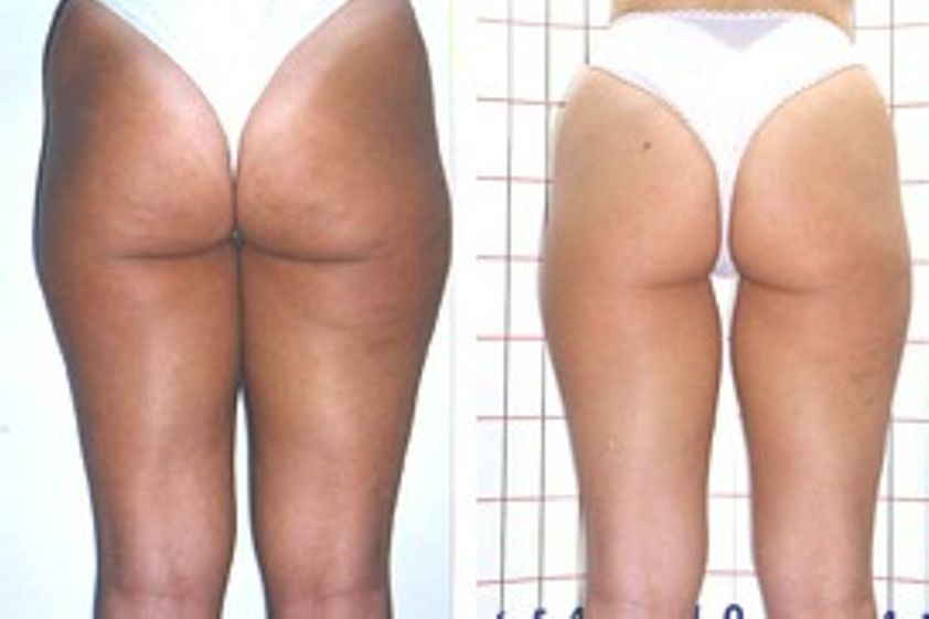 Tratamientos celulitis antes y después - 269411