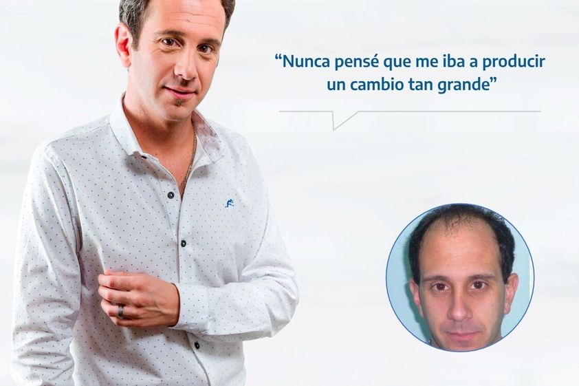 Implante capilar antes y después - 852692