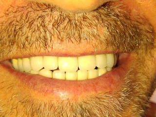 REHABILITACION ORAL COMPLETA - CASO 2 - POST OPERATORIO
