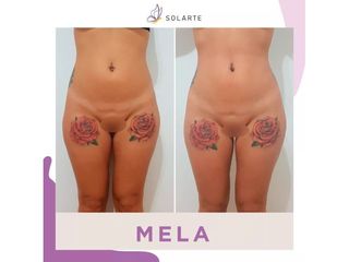 MELA