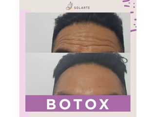 Botox - Dra. Haylen Lozano Solarte