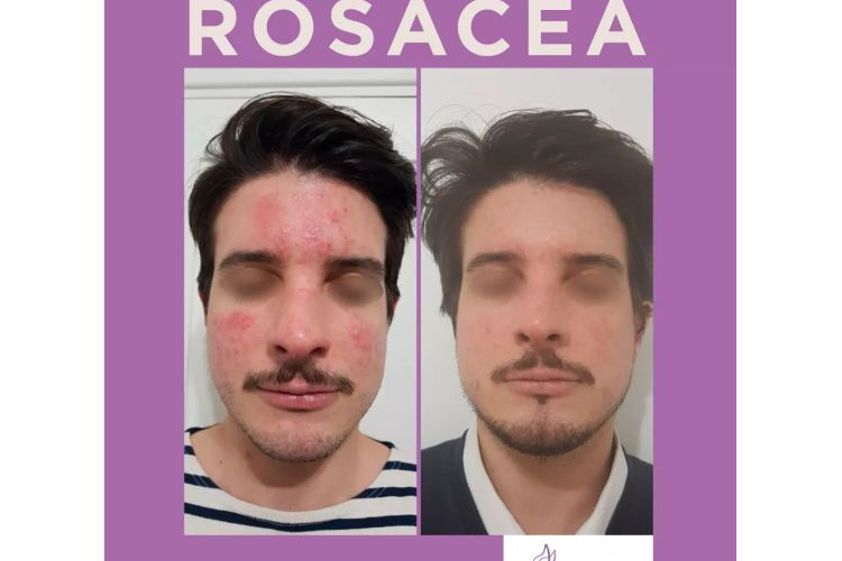 Rosácea antes y después - 701055
