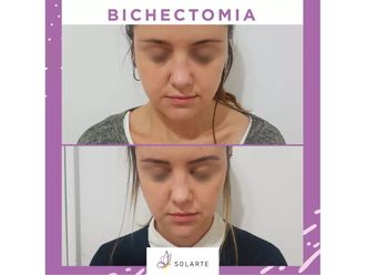 Bichectomia - 701056