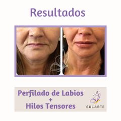 Relleno de labios + Hilos Tensores - Dra. Haylen Solarte