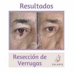 Resección de Verrugas - Dra. Haylen Lozano.