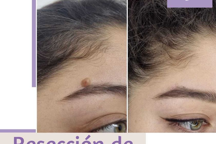 Lunares antes y después - 824173