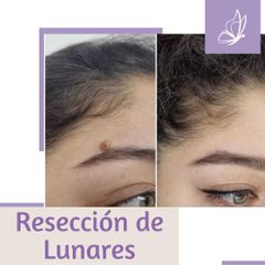 Resección de Lunares - Dra. Haylen Lozano