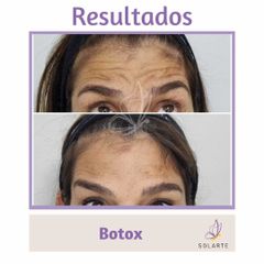 Botox - Dra- Haylen Lozano
