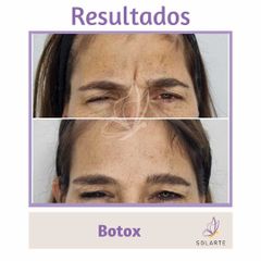 Botox - Dra. Haylen Lozano