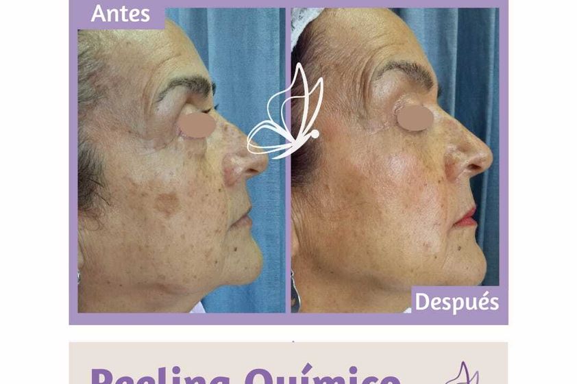 Peeling antes y después - 824526