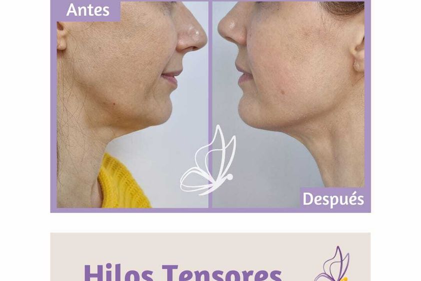Hilos tensores antes y después - 824530