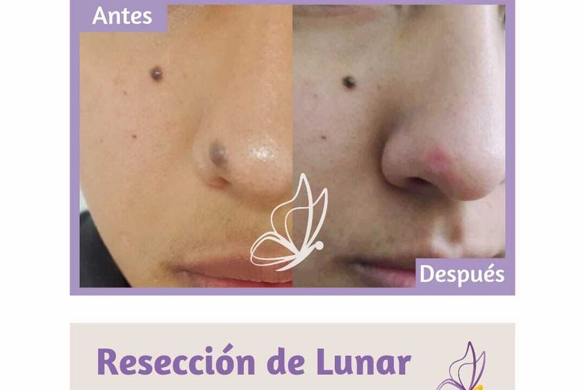 Lunares antes y después - 853876