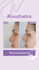 Rinomodelación - Dra. Haylen Solarte