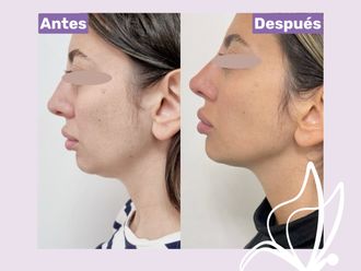 HIFU antes y después - 876234