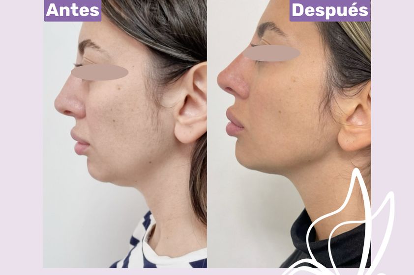 HIFU antes y después - 876234