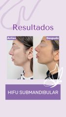 Hifu - Dra. Haylen Solarte