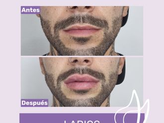 Relleno de labios antes y después - 876235