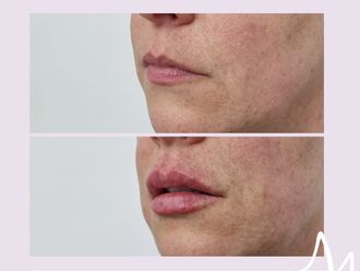 Relleno de labios antes y después - 876236