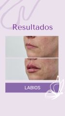 Rellenos de Labios - Dra. Haylen Solarte
