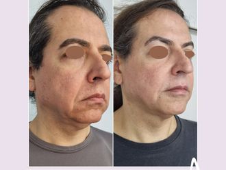 Rejuvenecimiento facial antes y después - 876237