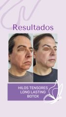 Rejuvenecimiento Facial - Dra. Haylen Solarte