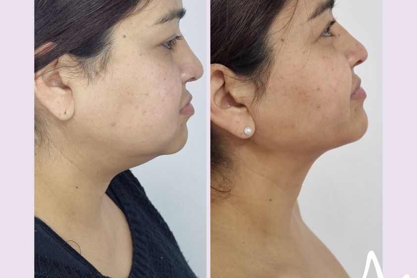 Lipopapada antes y después - 876239