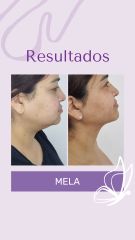 Papada MELA - Dra. Haylen Solarte