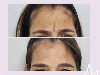 Botox antes y después - 876240