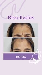 Botox - Dra. Haylen Solarte