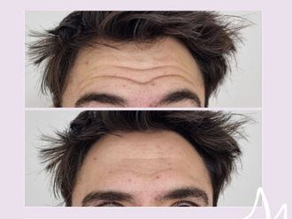 Botox antes y después - 876241