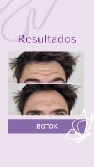 Botox - Dra. Haylen Solarte