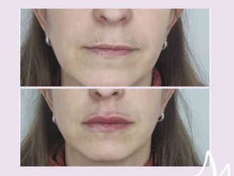 Relleno de labios antes y después - 876242