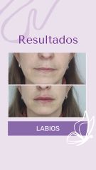 Rellenos de Labios - Dra. Haylen Solarte