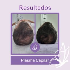 Plasma capilar - Dra. Haylen Solarte