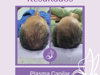 Plasma Rico en Plaquetas antes y después - 876244